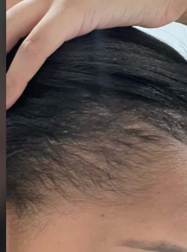 Image for article titled Black Women Using Rogaine to Regrow Their Edges Share Amazing Before, After Pics on Tiktok