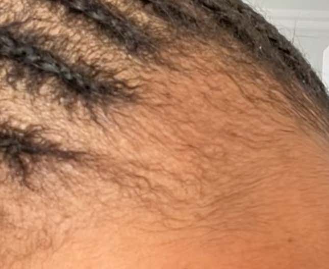 Image for article titled Black Women Using Rogaine to Regrow Their Edges Share Amazing Before, After Pics on Tiktok