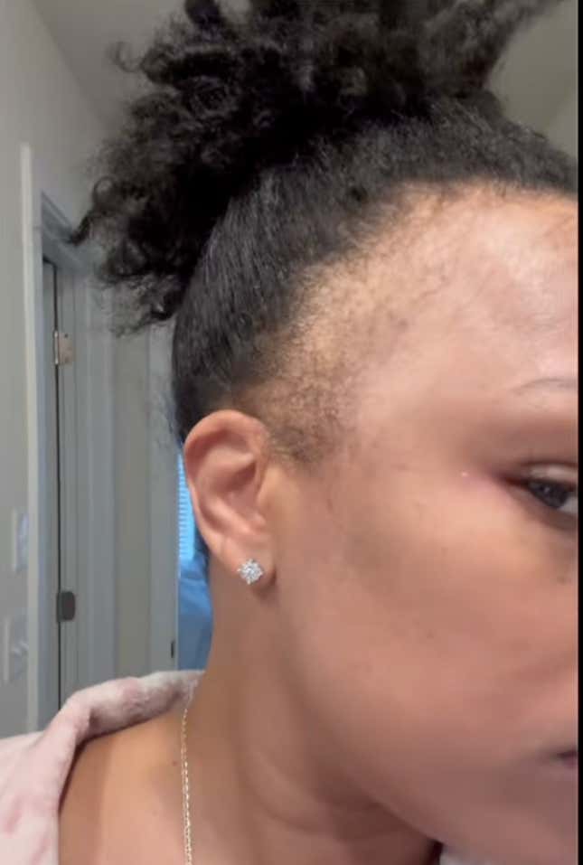 Image for article titled Black Women Using Rogaine to Regrow Their Edges Share Amazing Before, After Pics on Tiktok