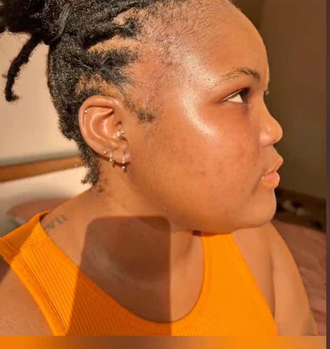 Image for article titled Black Women Using Rogaine to Regrow Their Edges Share Amazing Before, After Pics on Tiktok