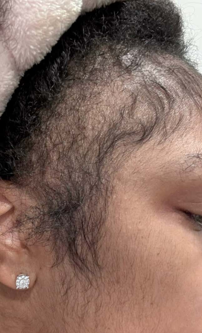 Image for article titled Black Women Using Rogaine to Regrow Their Edges Share Amazing Before, After Pics on Tiktok